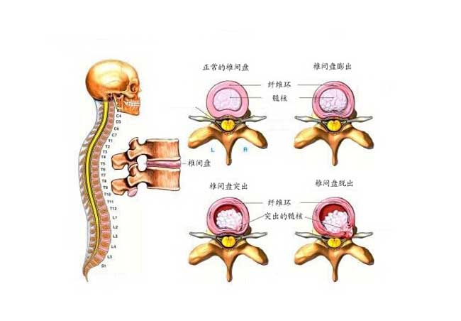 腰椎间盘突出症