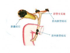 胆结石是怎么形成的?