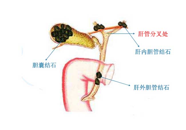 胆结石是怎么形成的