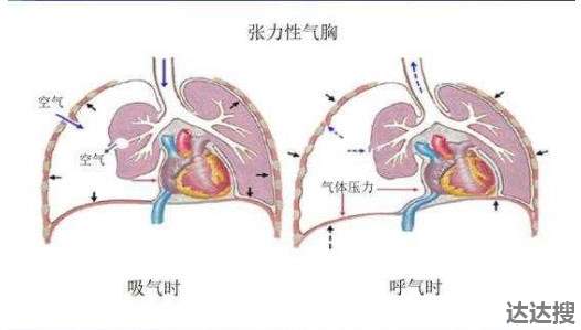 男子空中突发气胸险窒息2