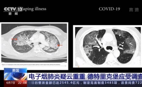 溯源疑云：2019年美国电子烟肺炎与新冠症状几乎无异